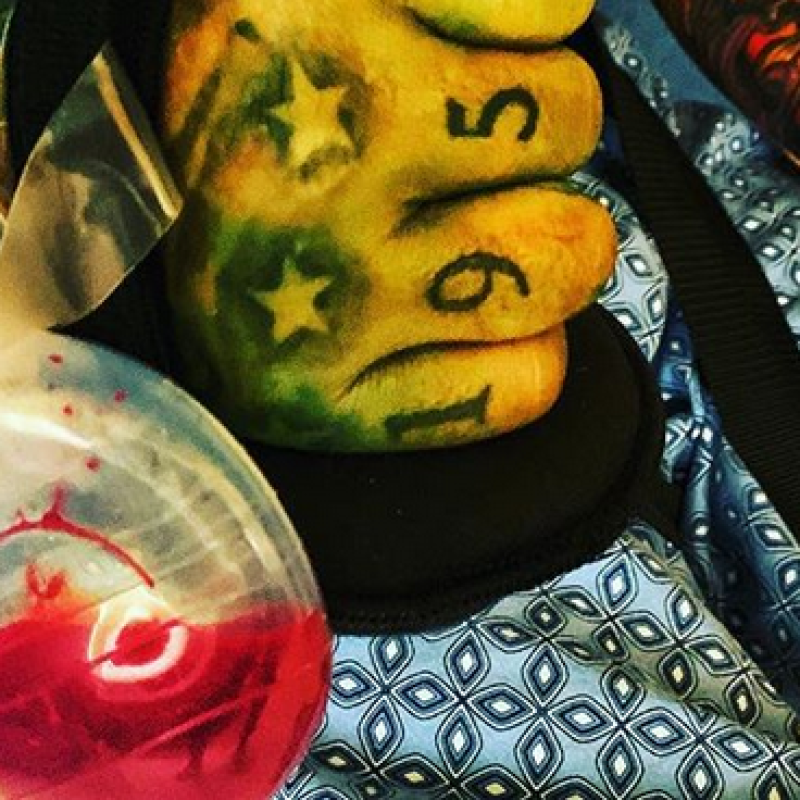 NIKKI SIXX Undergoes Surgery