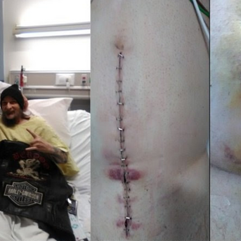JC BERDOO RELEASED TO GO HOME AFTER 9TH SURGERY LAS VEGAS