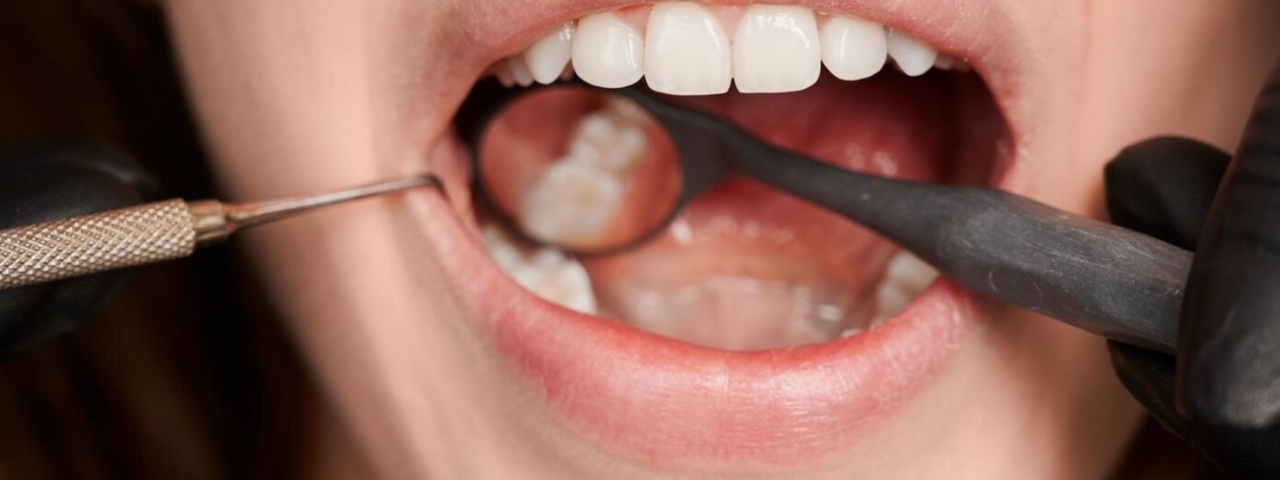 Wisdom Teeth Removal Adelaide