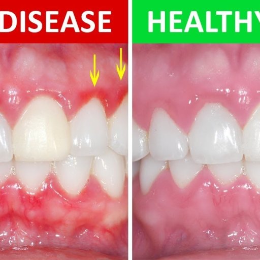 Bright Gum