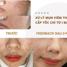 xu-ly-mun-viem-tham-do-cap-toc-chi-tu-mot-buoi
