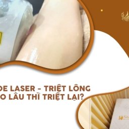 cong-nghe-triet-diode-laser-triet-long-bao-lau-thi-triet-lai