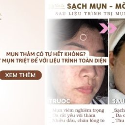 mun-tham-co-tu-het-khong-xu-ly-mun-triet-de-voi-lieu-trinh-toan-dien